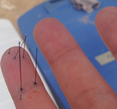 Wilcox’s finger with venomous sea urchin spines. (Image: Christie Wilcox)